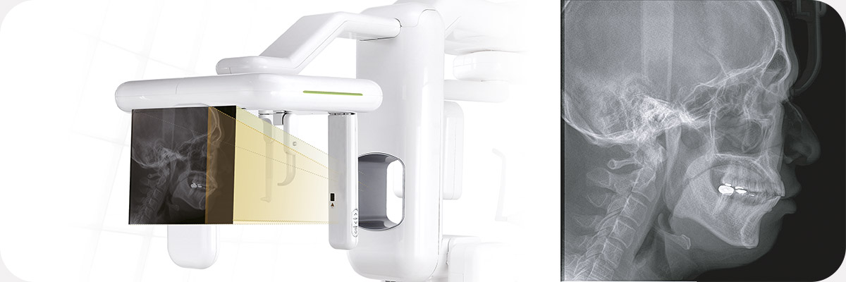 Латеральная проекция дентального компьютерного 3D томографа Genoray Volux 55 с цефалостатом.jpg Латеральная проекция дентального компьютерного 3D томографа Genoray Volux 55 с цефалостатом.jpg